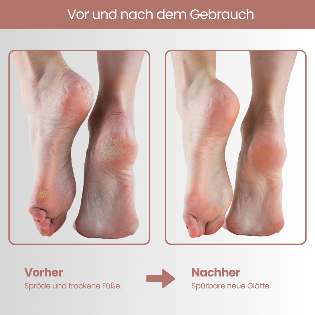 Vorher Nachher Vergleich der Fußmaske: Spürbar glattere und weichere Füße nach Anwendung – entfernt trockene, spröde Haut für eine intensive Fußpflege.