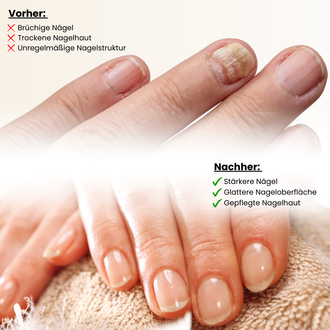 Nail Care Pen Vorher-Nachher-Ergebnis: Sichtbare Verbesserung bei brüchigen Nägeln und trockener Nagelhaut. Die pflegende Formel stärkt die Nägel, glättet die Oberfläche und sorgt für gesunde, gepflegte Nagelhaut. Ideal zur effektiven Nagelpflege und Regeneration.