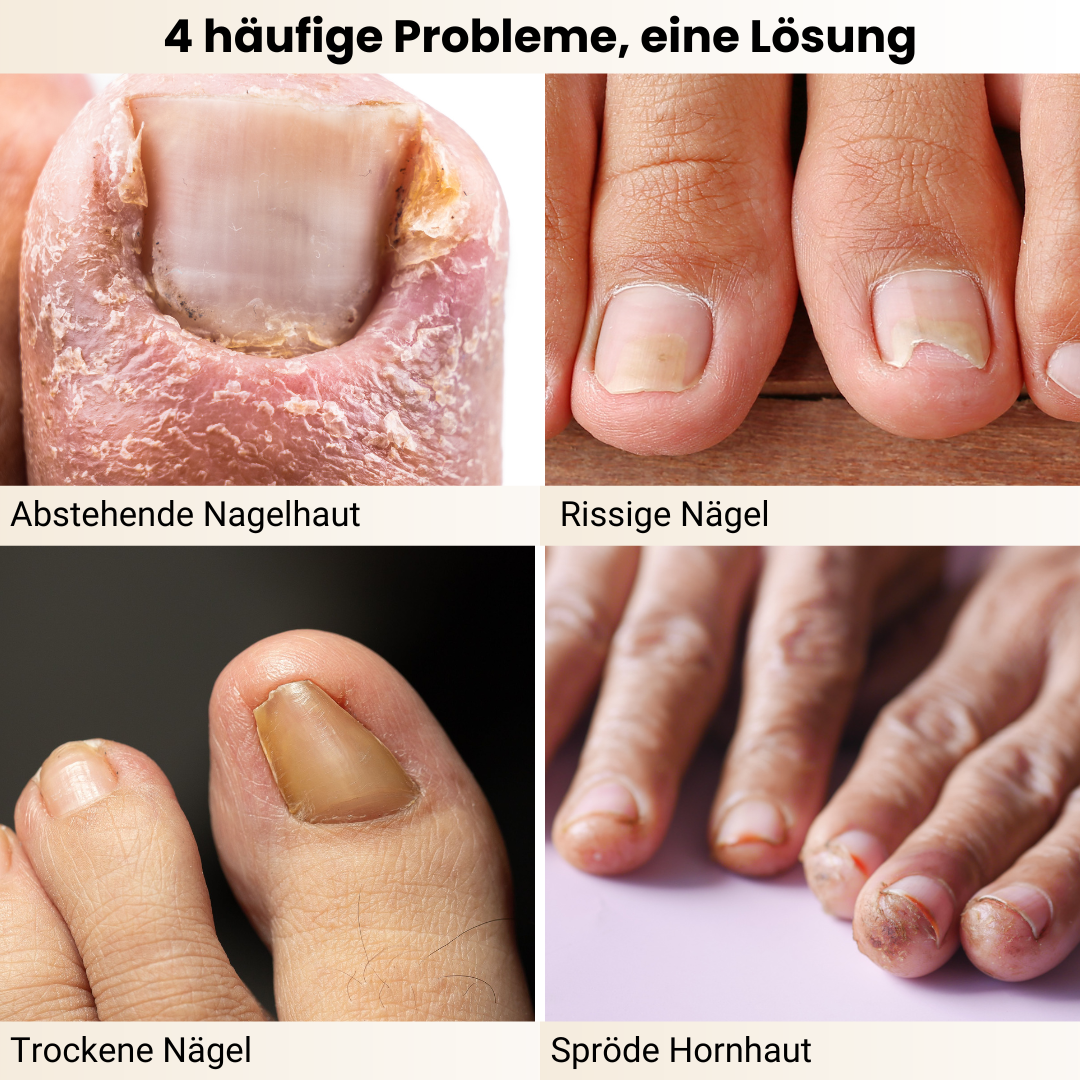 Nagelprobleme effektiv behandeln: Der Nail Care Pen hilft bei abstehender Nagelhaut, rissigen Nägeln, trockenen Nägeln und spröder Hornhaut. Die pflegende Formel stärkt, regeneriert und schützt für gesunde, widerstandsfähige Nägel.