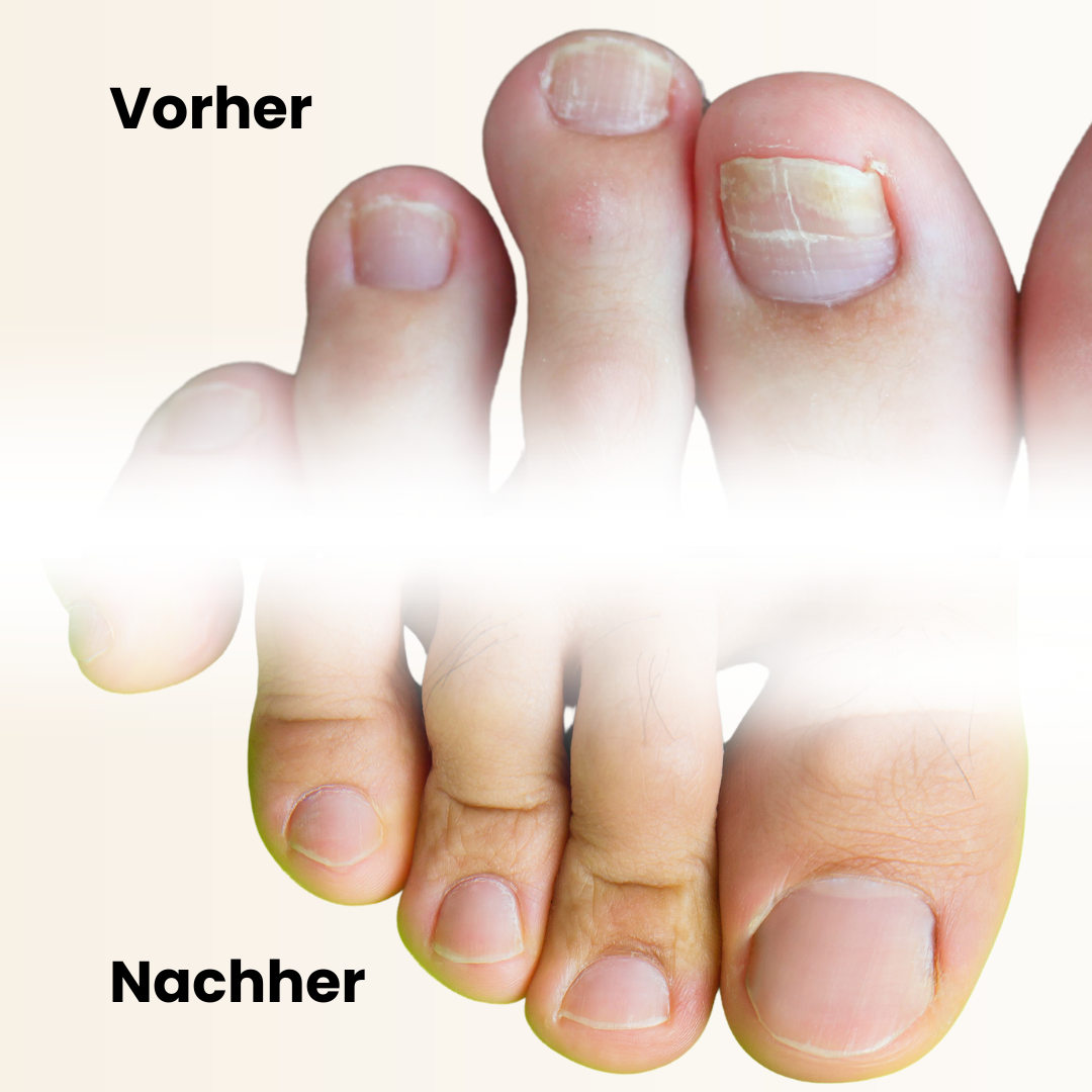 Vorher-Nachher-Ergebnis mit dem Nail Care Pen – Effektive Nagelpflege gegen Nagelpilz, brüchige und verfärbte Nägel. Sichtbare Verbesserung für starke, gesunde Nägel. Ideal zur täglichen Anwendung für intensive Regeneration und Schutz.