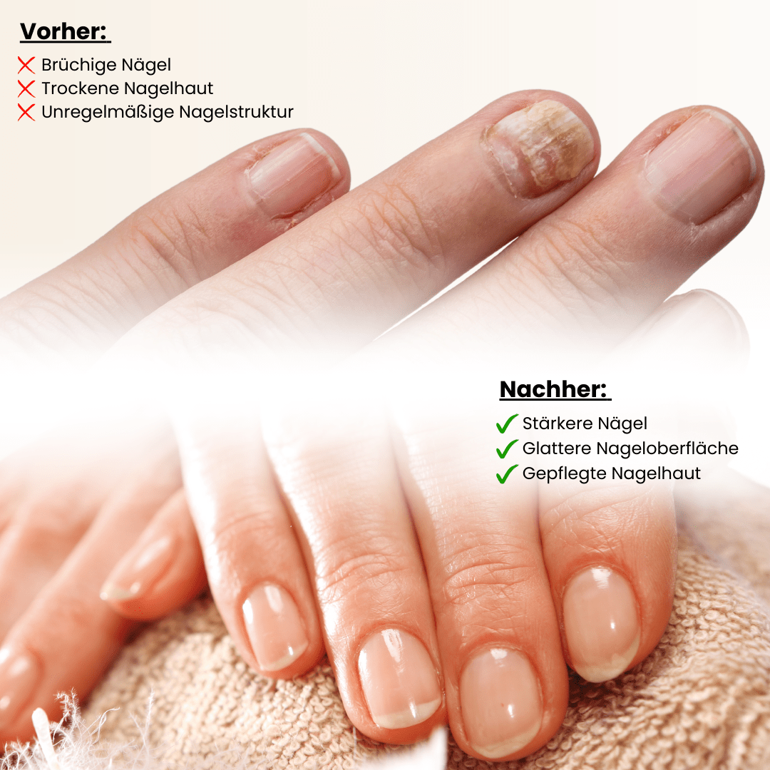 Nail Care Pen – Gegen Nagelpilz & brüchige Nägel – Doktor Health