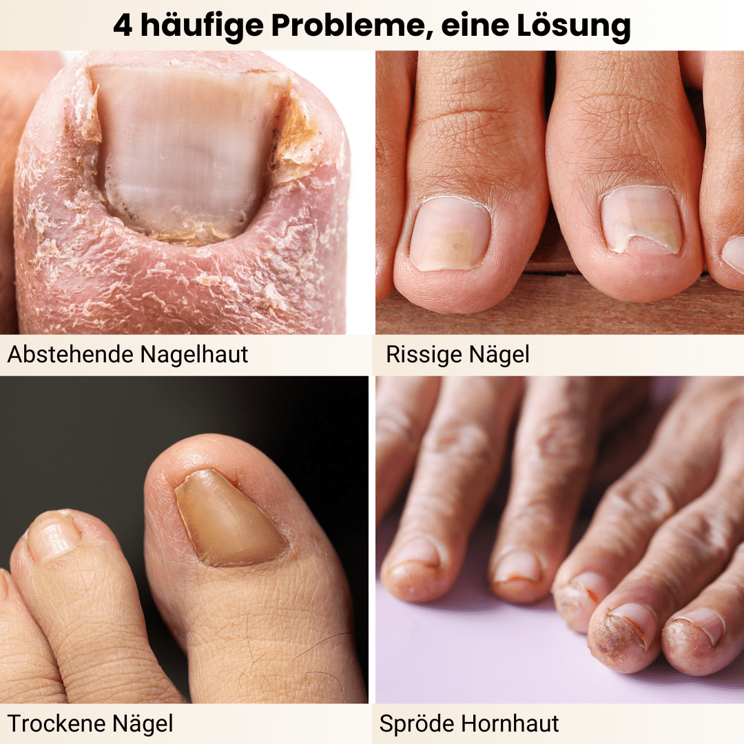 künstlicher nagel bei nagelpilz Nail Care Pen – Gegen Nagelpilz & brüchige Nägel – Doktor Health